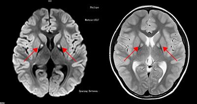 Case report: Novel compound heterozygous variants in the PANK2 gene in a Chinese patient diagnosed with ASD and ADHD